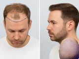 Från tunnhårig till turnéredo? Hårtransplantation i Sverige med exempel från Nordic Hair Clinic